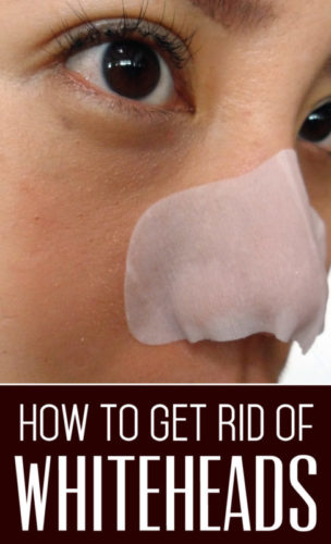 10 Ways To Get Rid Of Whiteheads — Info You Should Know 