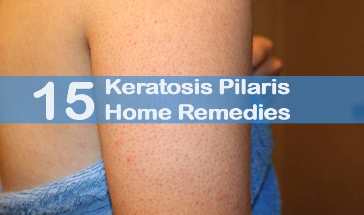 home-remedies-for-keratosis-pilaris-bumps-on-the-skin-vrogue-co