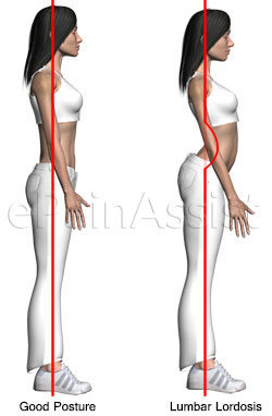 lordosis