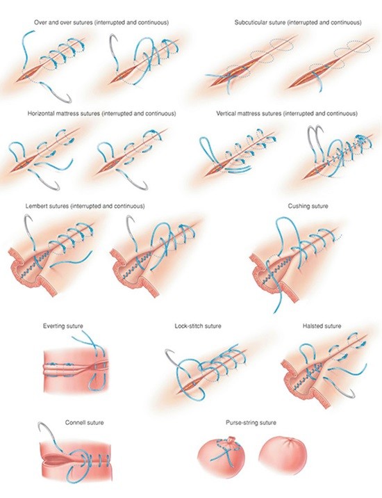 11-ways-to-stitch-a-wound-info-you-should-know